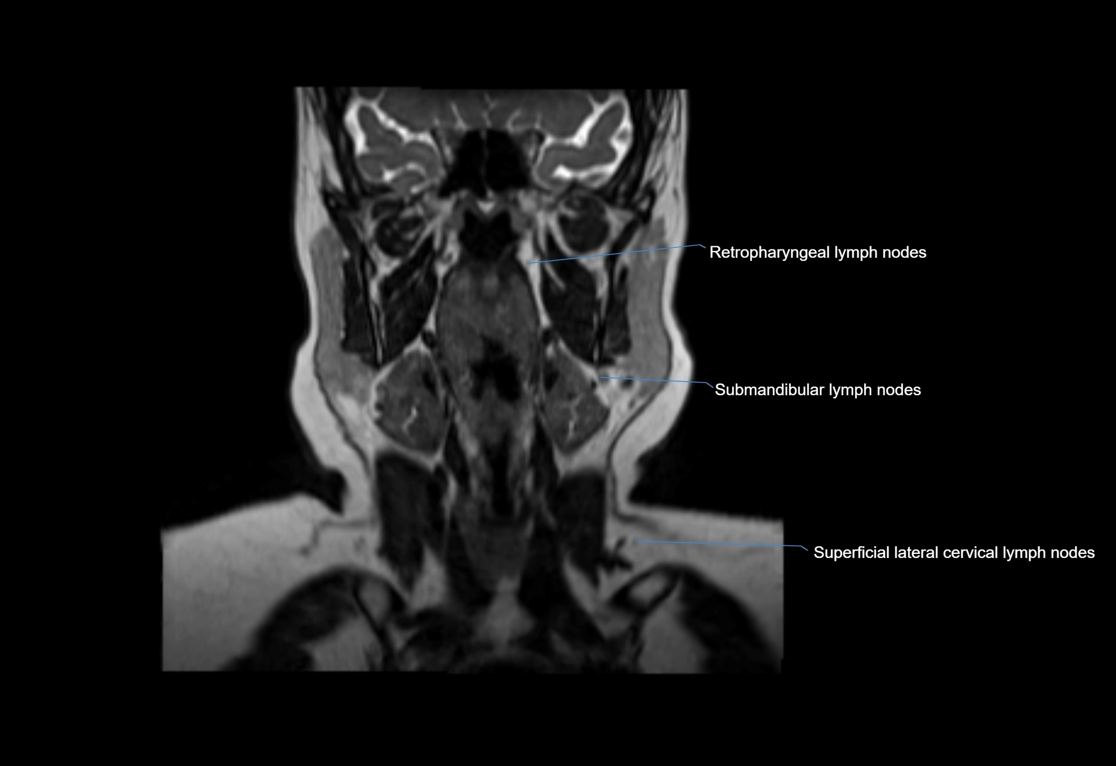 Neck coronal lymph node cross sectional MRI anatomy 3T MRI  image-img-00001-00046.webp